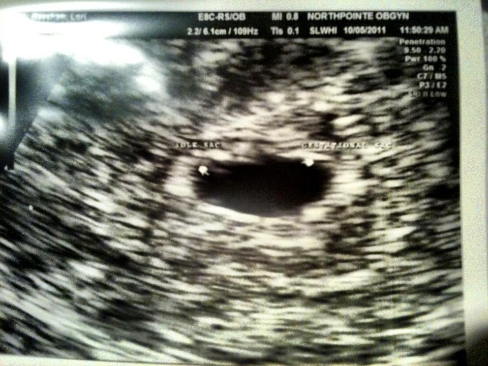 First sonogram of Claire